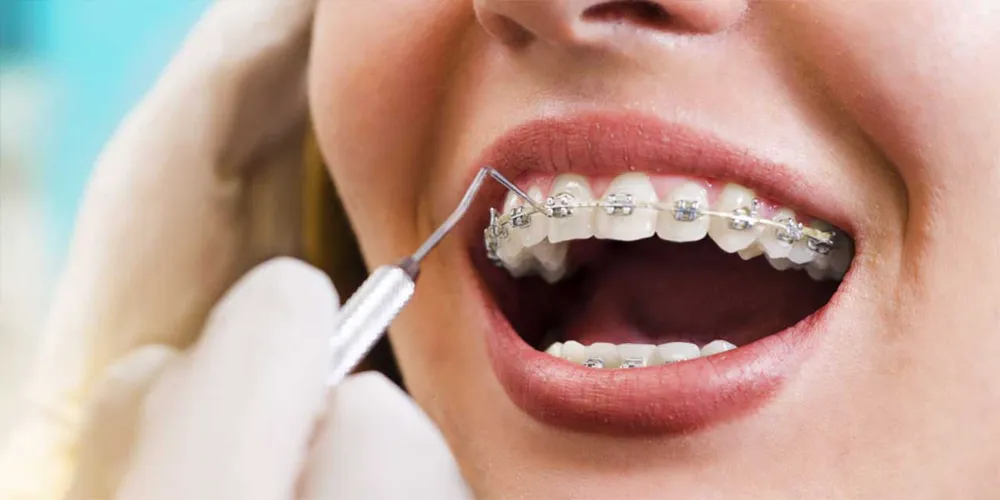 Ortodonti nedir? Ortodonti ne yapar?