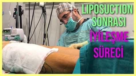 Liposuction Sonrası Şişlik Ne Zaman İner?