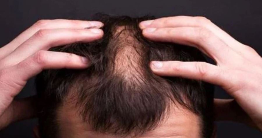 Saç kıran hastalığı nedir? Nasıl bulaşır, tedavi edilmezse ne olur? Kalıcı mı, nasıl geçer?