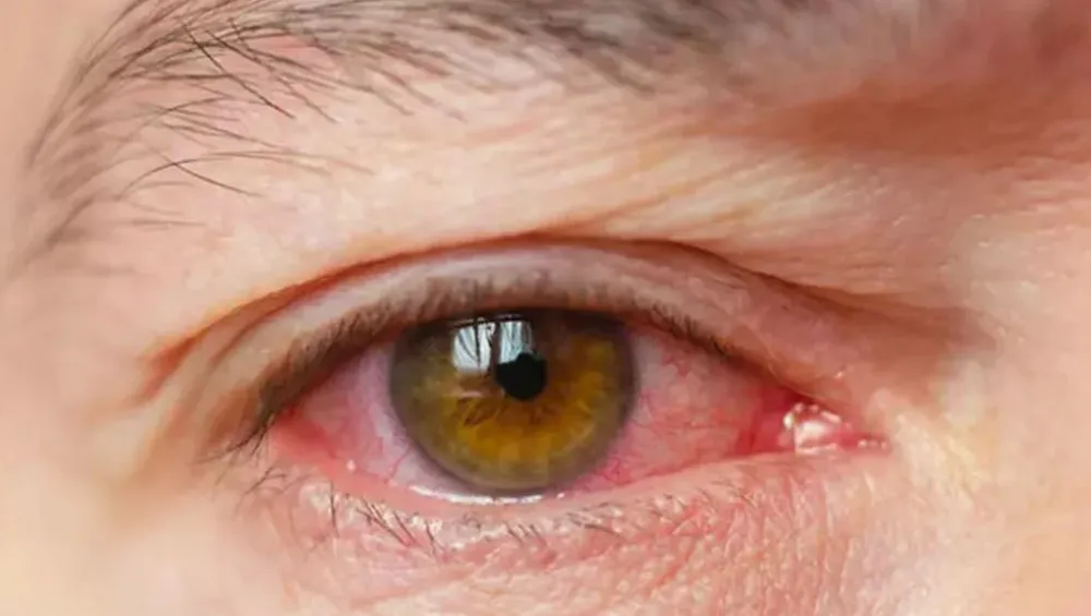 Uzman İsim Uyardı: Strese Bağlı Göz Hastalıkları Erkeklerde Çok Sık Görülüyor!