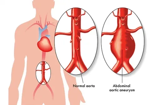 Damarlardaki sessiz tehlike  Aort anevrizması nedir?