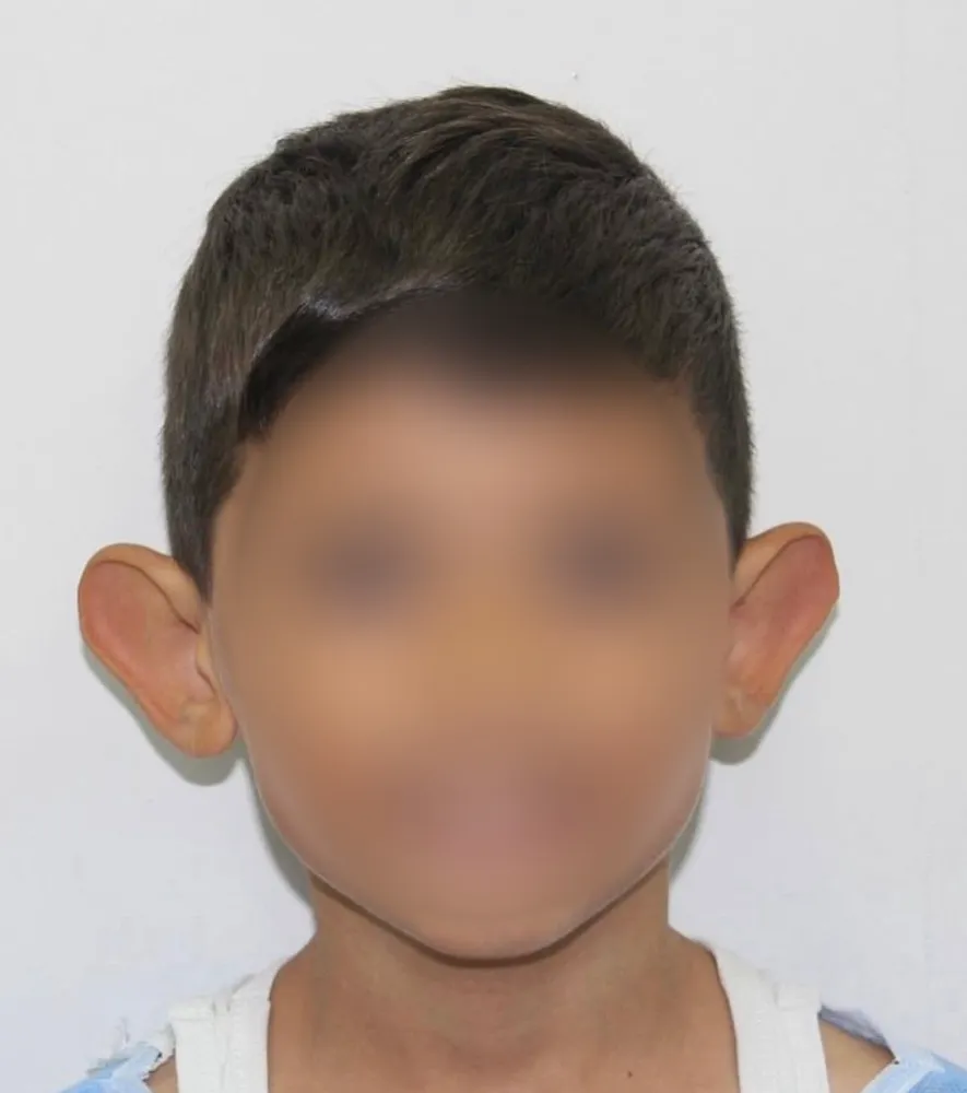 ‘Kepçe kulak’ sorunu çocuklarda özgüveni zedeliyor