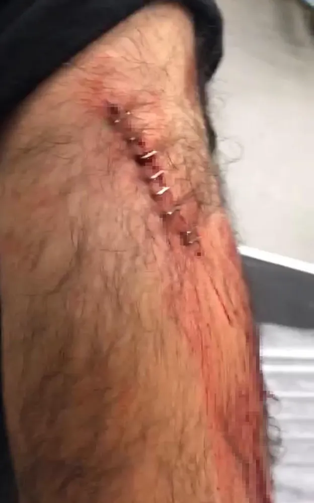 Şanlıurfa’da Öğretmene Sokak Ortasında Jiletli Saldırı