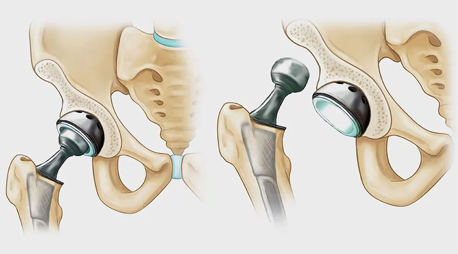 Kalça Kemiği Protezi Neden Gerekir ve Çeşitleri Nelerdir?