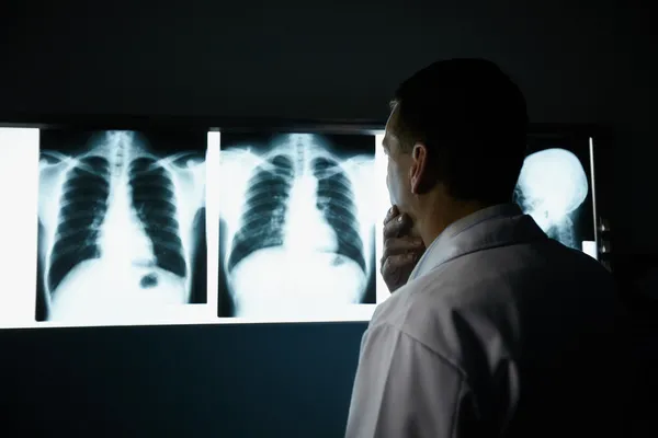Akciğer Kanseri Nasıl Tedavi Edilir? Akciğer Kanseri Belirtileri Nelerdir?