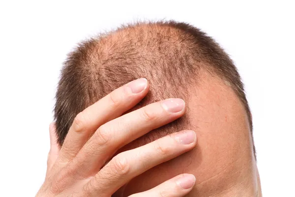 Saçlarda Seyreklik Neden Olur? Kellik Sorunu Nasıl Çözülür?