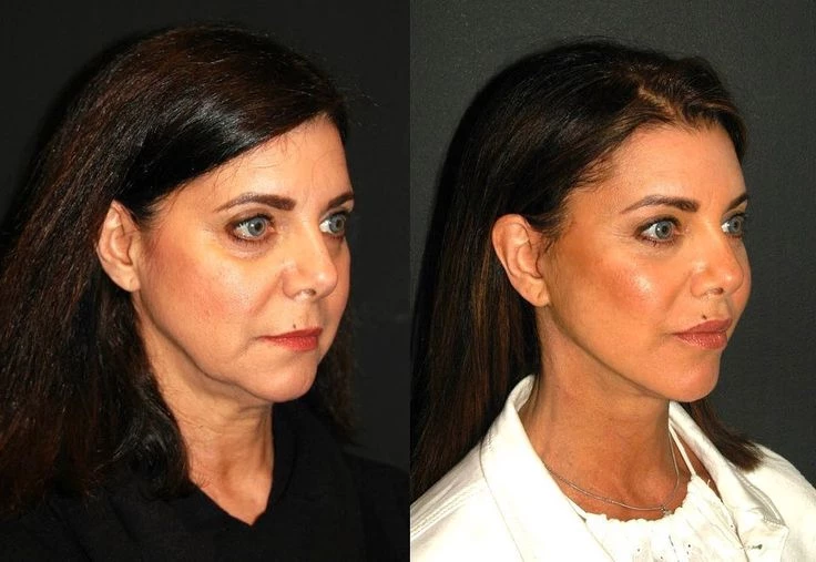 Face Lift Nedir? Face Lift Operasyonu Nasıl Yaptırılır? Face Lift Operasyonu Ne İşe Yarar?