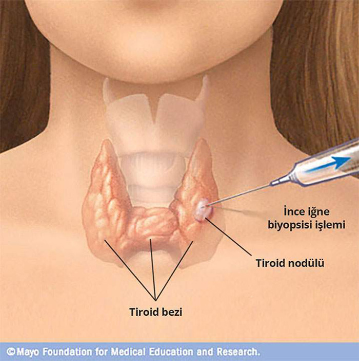 Tiroid Nodülleri: Boyutları ve Kanser Riski Hakkında Bilmeniz Gerekenler