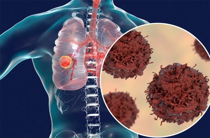 Akciğer kanseri hapı geliştirildi! Ölüm riskini yüzde 51 azaltıyor